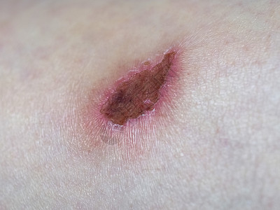 伤疤组织真皮瘢痕手臂伤口药品卫生疤痕皮肤感染医疗背景