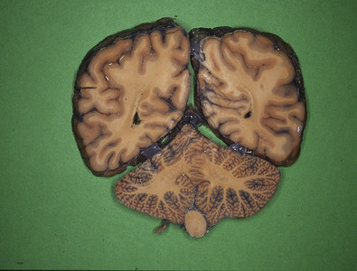 人类大脑被神经切片回旋器官诊断科学横截面颅骨考试药品小脑脊髓背景图片