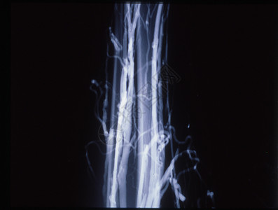X光片的腿静脉变动事故蓝色静脉曲张烛光医生诊断考试关节黑色x光背景图片