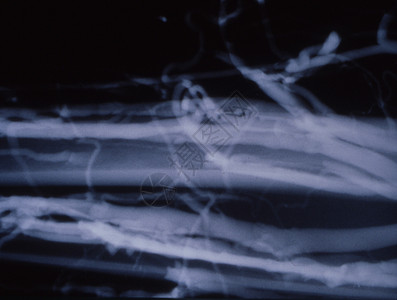 X光片的腿静脉变动x光医生黑色医院烛光辐射诊断静脉曲张关节蓝色背景图片