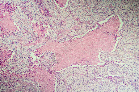 显微镜下鳞状细胞癌病变组织 100疾病组织学药品病理科学诊断细胞癌症考试宏观背景图片