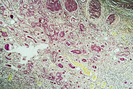 显微镜下的肾脏病组织萎缩 100x科学病理药品诊断肾炎肾小球肾脏疾病考试细胞背景