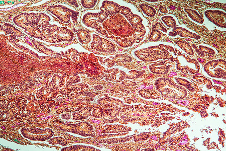 血液肿瘤第1节 肿瘤组织组织部分 1 含有葡萄和淋巴细胞的睾丸素放大镜生物学宏观绒毛薄片科学诊断癌症药品疾病背景