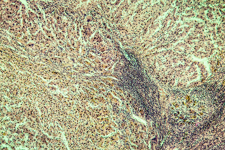 酒精滥用后 肝硬化组织感染了100x显微术细胞病理药品宏观疾病科学背景图片