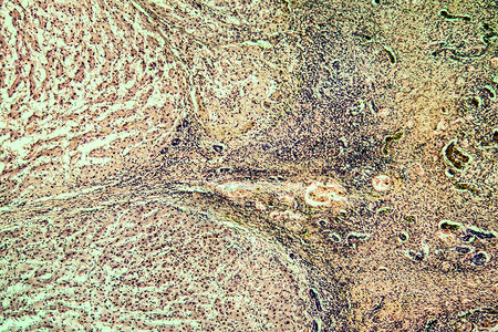 酒精滥用后 肝硬化组织感染了100x科学药品宏观细胞疾病显微术病理背景图片