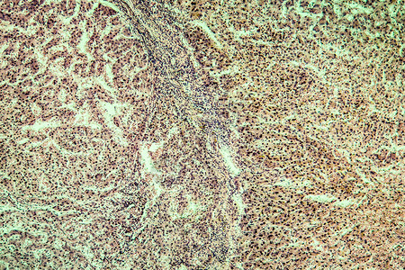 酒精滥用后 肝硬化组织感染了100x科学药品细胞宏观显微术病理疾病背景图片