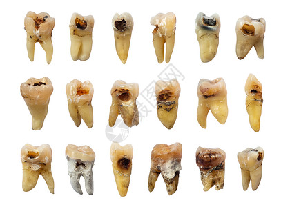 一组牙齿牙齿(牙齿腐烂) 氟化物和微积分 孤立的背景背景图片
