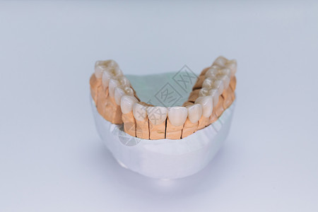 全瓷贴面锆冠贴面 在白色背景上隔离的石膏模型上贴有贴面的陶瓷牙齿 石膏模型陶瓷桥背景