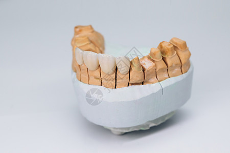 全瓷贴面金属免费的陶瓷牙冠 石膏模型上的牙科体温器 在钢筋模型上使用背景