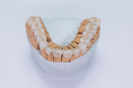 超薄瓷贴面石膏模型上的陶瓷牙冠 在石膏模型上完成新的陶瓷牙桥贴面 牙科贴面躺在实验室的白色背景上背景