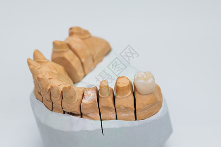 全瓷贴面不含金属的陶瓷牙齿 在白色背景上隔离的陶瓷贴面 牙科实验室石膏模型上的金属陶瓷冠背景