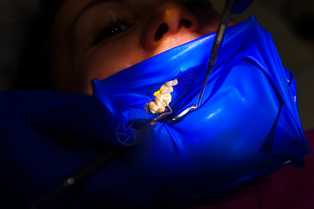 在橡胶大坝 橡胶大坝和牙科镜的隔绝物上用白色合成树脂填牙后 将病人的嘴缝合牙科卫生尖端框架器械办公室乳胶牙医微笑围堰背景