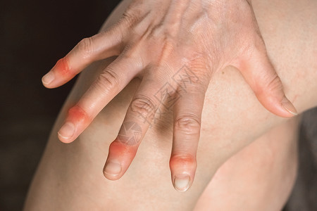 年长妇女的手有伤痛的手指 手指处理概念卫生疼痛疾病手臂状况保健风湿畸形女性压力背景图片