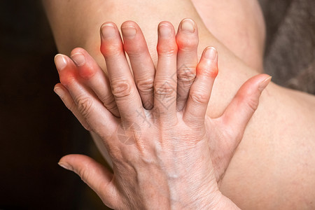 年长妇女的手有伤痛的手指 手指处理概念女性状况保健疼痛药品医生风湿伤害老年手臂背景图片