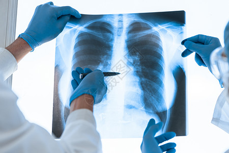 肺虚医疗同事在讨论肺部X光片的问题 笑声疾病肺炎男性放射科射线x射线技术哮喘诊所工作背景