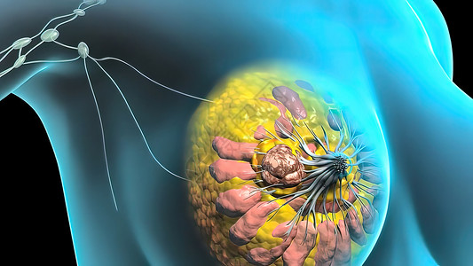 具有乳腺病理学的  女孩  女性人的结构说明和缝合宏观化疗癌症科学硬化细胞淋巴瘤医生生物解剖学背景图片