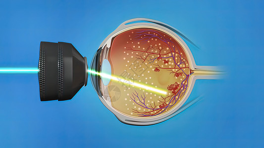 激光图标激光外科 眼激光治疗器材近视手术角膜风险瞳孔程序眼镜屏幕眼科背景