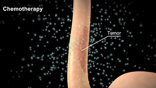 肿瘤靶向治疗化疗应用在肿瘤地区 肿瘤被清理干净了病人微生物学保健前列腺卫生预防组织癌症药品细胞背景