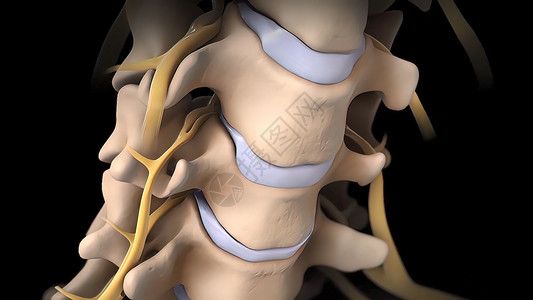 脊柱变形间脊椎盘片可能会变形 压缩神经的神经疼痛骨科骨骼手术柱子姿势疗法叶片药品诊断背景