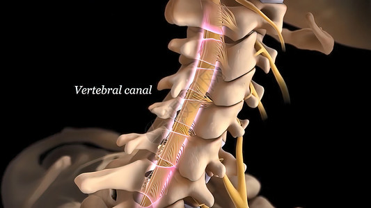 脊柱外科运河骨赘高清图片