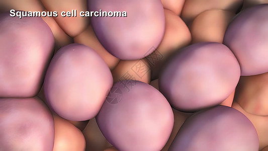 尿路上皮癌死亡科学高清图片