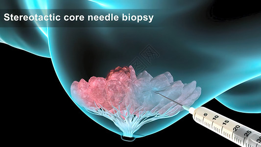 具有乳腺病理学的  女孩  女性人的结构说明和缝合细菌化疗生物防御癌症宏观疾病胸部技术生物学背景图片