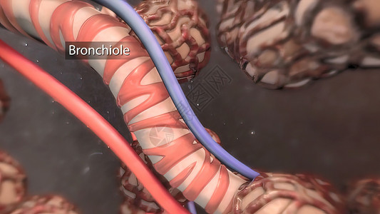 气肿细支气管囊性纤维化高清图片