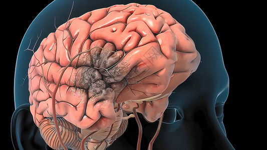 动脉瘤中脑血管痉挛高清图片