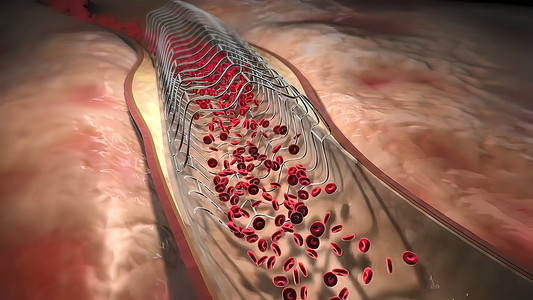 冠状动脉造影血红蛋白细胞流经阻塞的动脉 导致动脉硬化疾病情况手术心脏病学医院保健支架诊断心血管心肌监视器背景