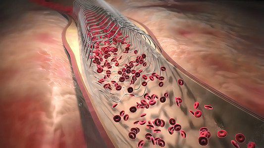 冠状动脉造影血红蛋白细胞流经阻塞的动脉 导致动脉硬化疾病监视器医生药品保健血管攻击医院心血管外科诊断背景