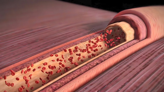 动脉粥样硬化斑块胆固醇斑块 神乐硬化和心脏病发作生理心室生物学男人图表视频动脉粥样硬化科学心血管肌肉背景
