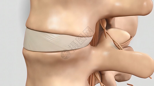椎管由于压力 脊椎骨的板块被粉碎姿势骨骼药品显示器外科诊断橙子手术颈椎病症状背景