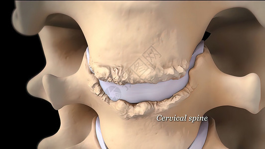 间充质干细胞3D 黑色背景的宫颈脊椎3D医学插图整脊髓质骨科椎骨药品疼痛柱子手术骨干椎间背景