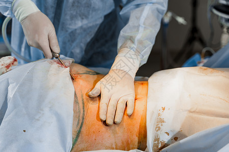 挺胸收腹外科医生在紧闭的谷状地区除去脂肪 塑料操作 以减少腹部和去除纤维素橘皮治疗整形组织医院手术重量护士身体皮肤背景