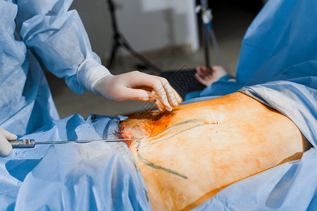 挺胸收腹外科医生给妇女做腹部生殖器瘤 在诊所进行整形手术 在医院里 可塑性手术技术重量橘皮操作形术身体病人女性药品塑料背景