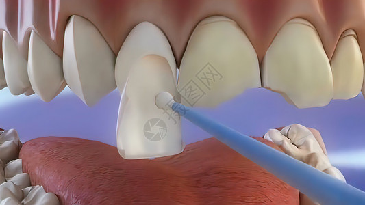 切碎破坏牙齿的过程牙龈聚合物健康检查微笑笑容牙医医院牙周手术背景图片
