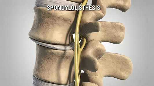 Lumbar 退化性疾病药品疼痛知识小路腰椎整脊光盘骨头注射身体背景图片