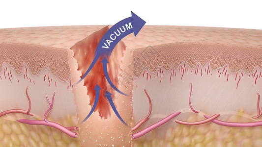 皮肤血管3D 皮肤伤口愈合时间的医疗说明动脉真皮纤维血管疾病静脉科学间质血肿图层背景