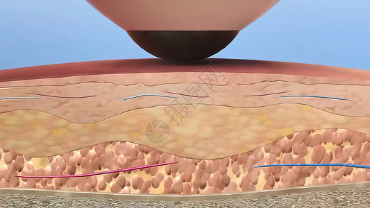 汽化激光皮肤再造外科3D医疗背景