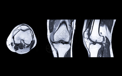 MRI Knee 联合三观点核磁共振膝盖软骨骨骼髌骨扫描电波运动射线诊断检查高清图片素材