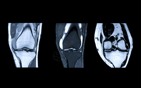 MRI Knee 联合三观点扫描器射线保健卫生药品骨科髌骨股骨磁铁创伤疼痛高清图片素材