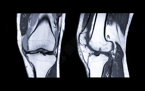 MRI Knee 联合三观点卫生软骨列表股骨积液电波扫描器创伤谐振药品射线照相高清图片素材