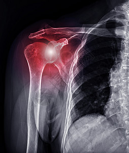 锁骨X射线肩膀联合诊断 肩膀交叉失调背景