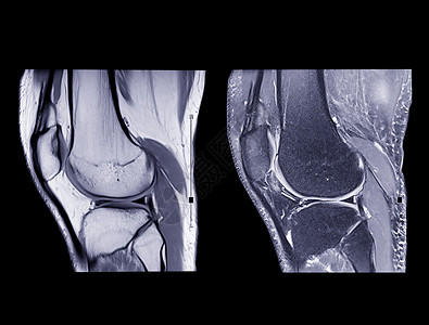 磁共振成像或MRI膝盖比较人表PDW和TIW视图医院股骨扭伤诊所核磁共振射线积液磁铁创伤软骨髁高清图片素材