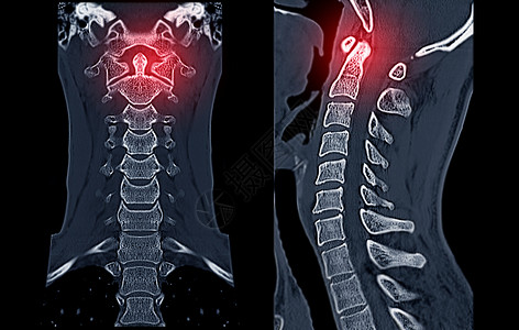 腺样体比较CT C脊椎或宫颈脊椎3D成像和人形图象脖子病人颅骨疝气考试痛苦脊柱创伤椎骨放射科背景