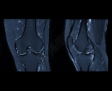 十字状光效与磁共振膝盖或膝合磁共振成像相比 可刺激脂肪抑制的轴 人形和冠状观察技术医院肌肉放射科保健创伤运动疼痛股骨扫描诊断背景