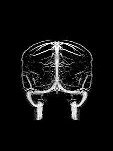 MRA脑和MRV脑射线中风谐振医院静脉扫描大脑出血肿胀形成图片