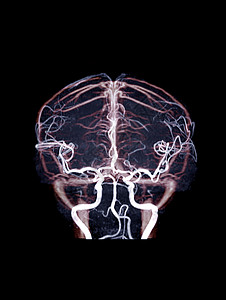 MRA脑和MRV脑鼻窦医院放射科动脉扫描速度病人大脑疾病诊断图片