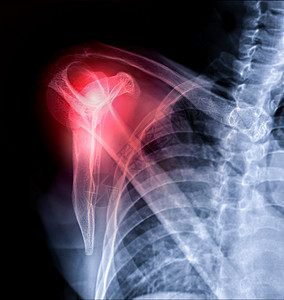 肩关节疼痛X射线肩膀合肩穿梭式观察 以诊断肩臂关节骨折症状骨骼器官创伤休息骨科肩胛骨医疗诊所疼痛背景