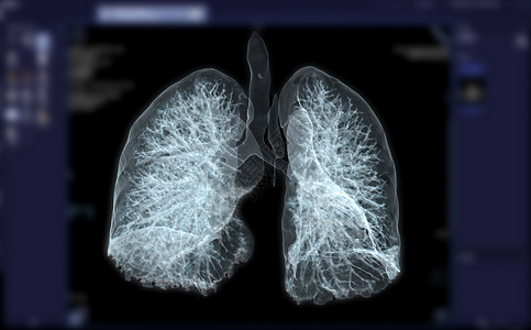 胸椎CT 胸腔或肺3D为诊断结果提供图象 肺结核 结核病和宫颈19癌症结核疾病心脏病学药品解剖学电脑放射科断层结节背景